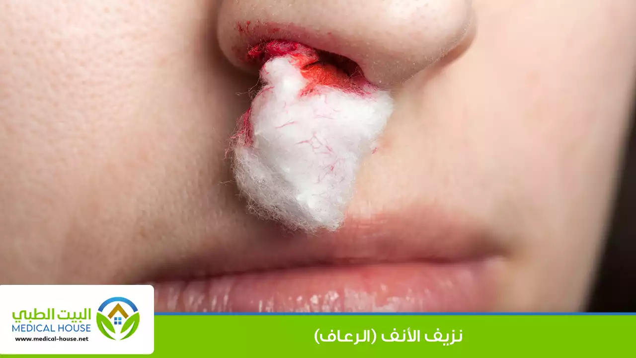 نزيف الأنف (الرعاف)