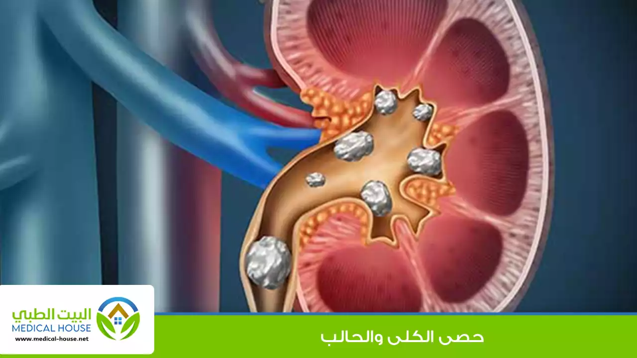 حصى الكلى والحالب
