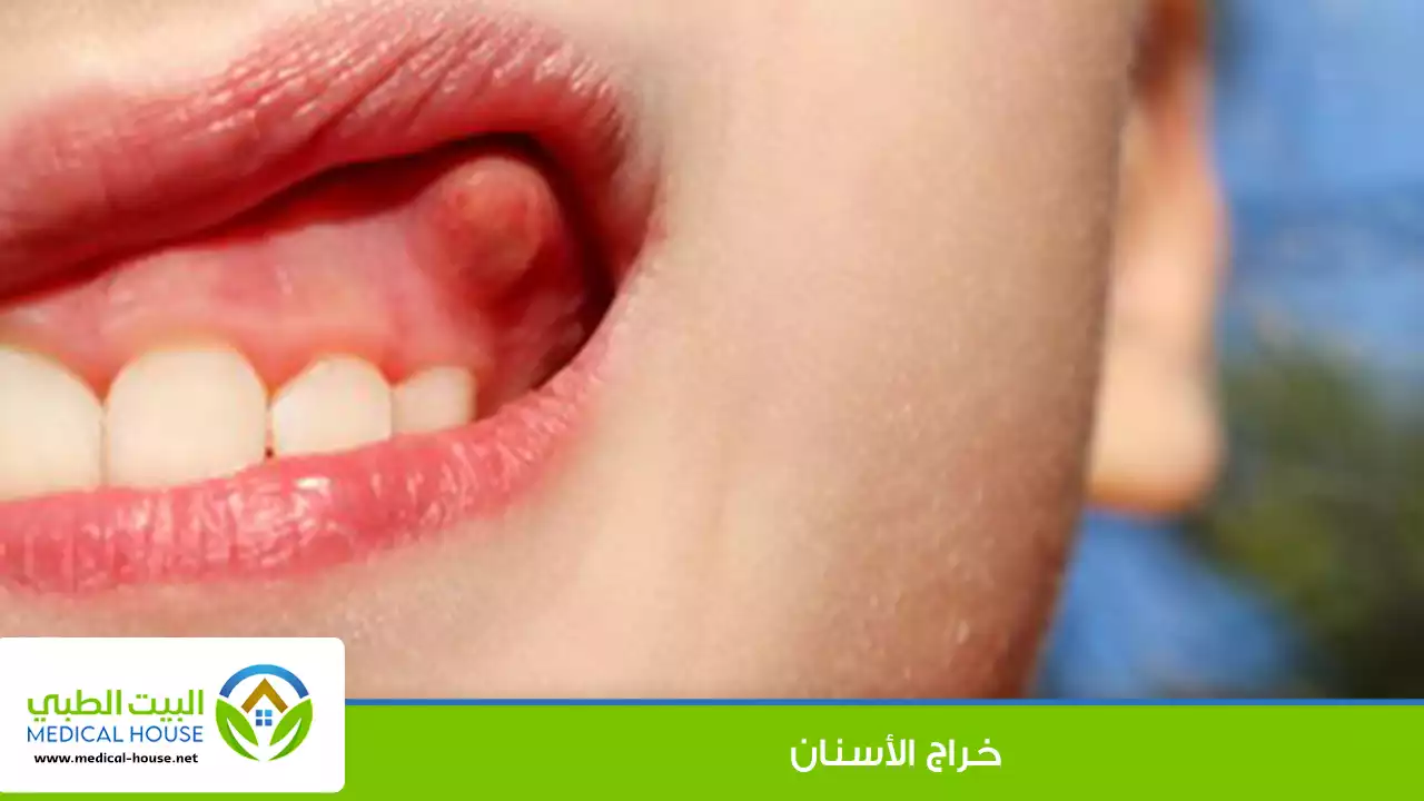 ما هو خراج الأسنان