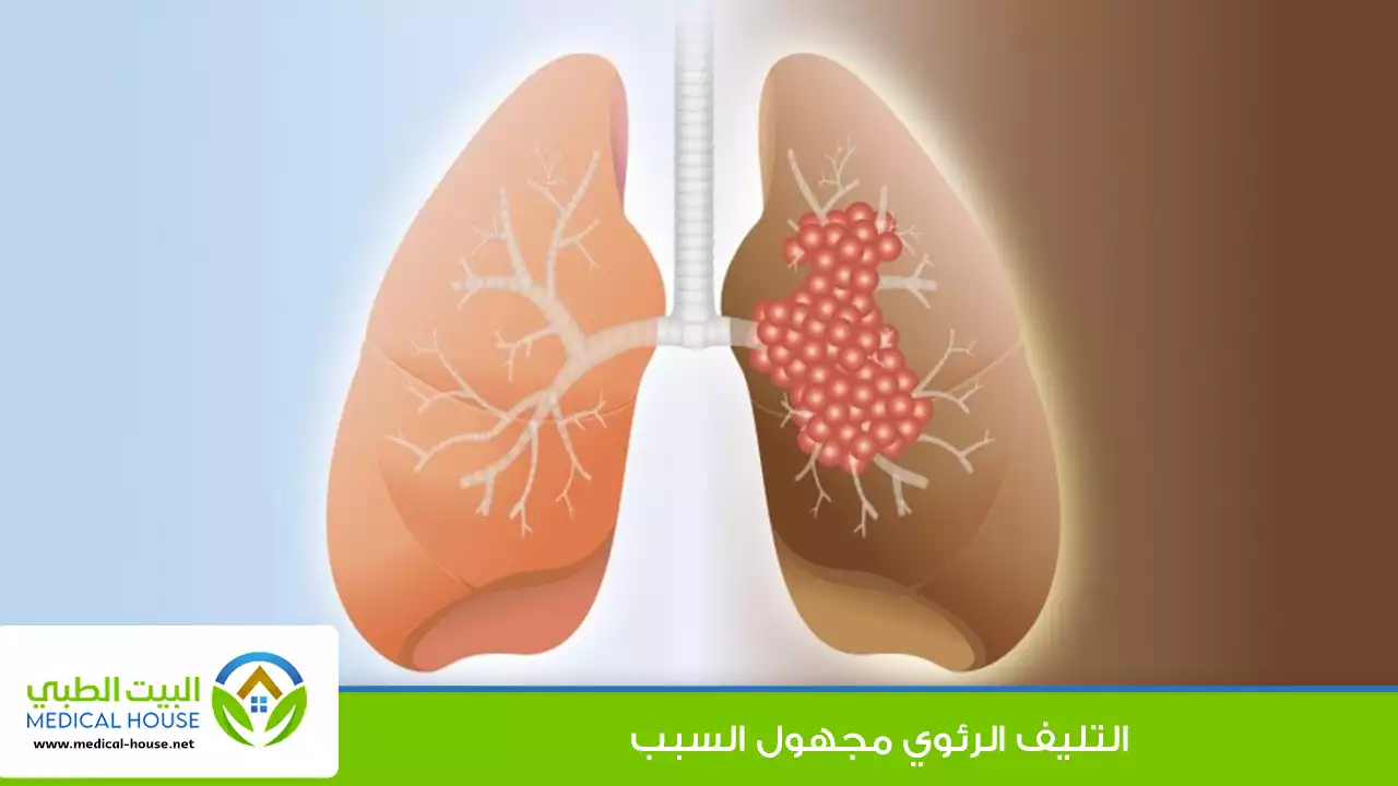 التليف الرئوي مجهول السبب