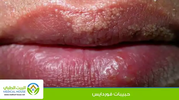 حبيبات فوردايس