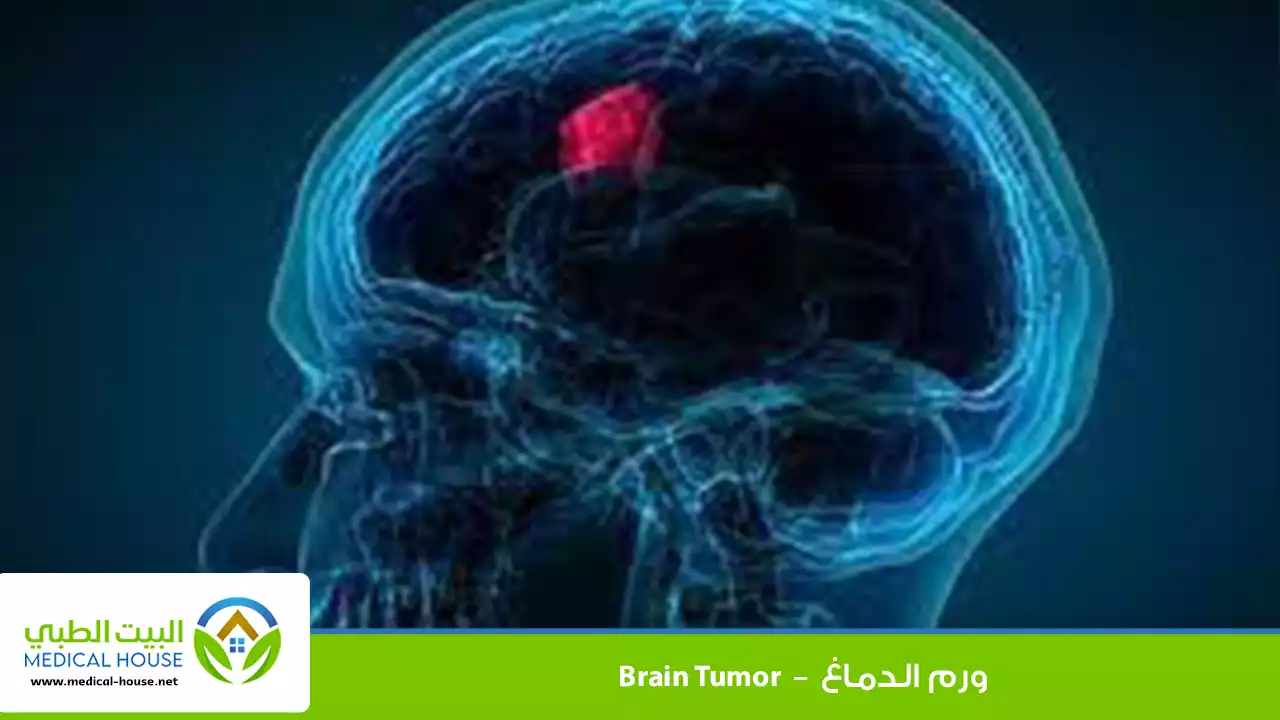 ورم الدماغ