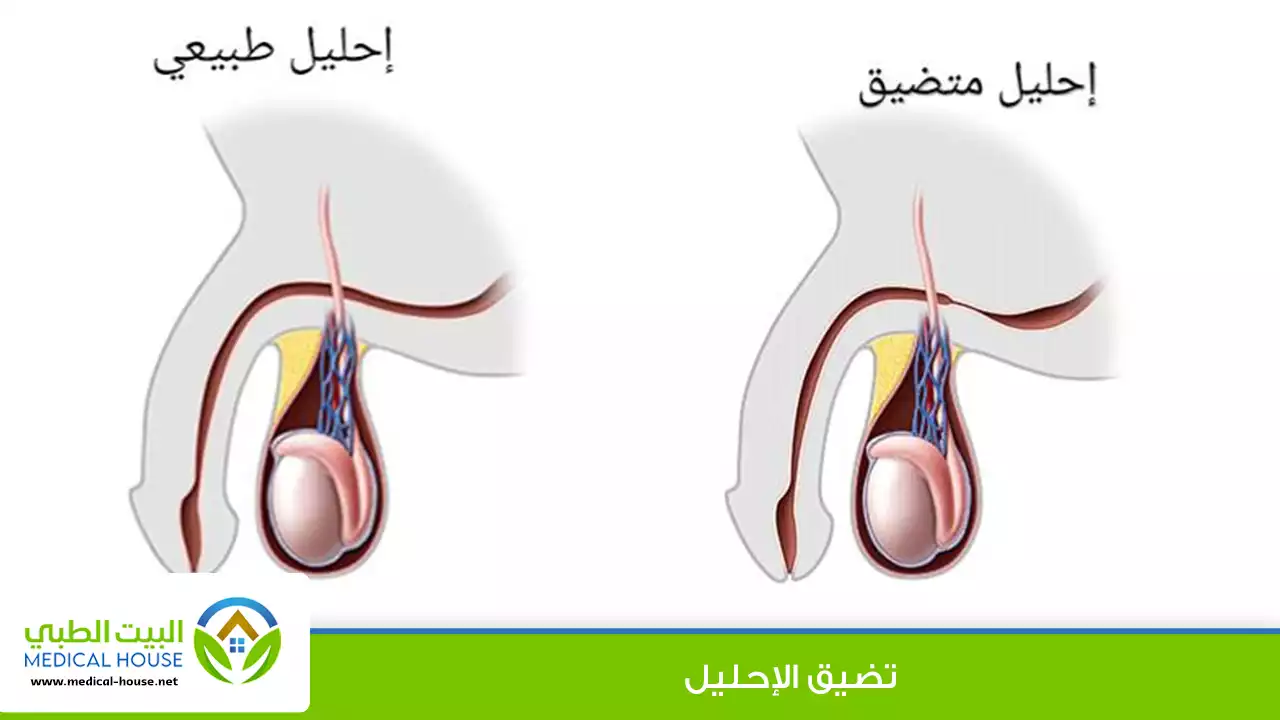 تضيق الإحليل