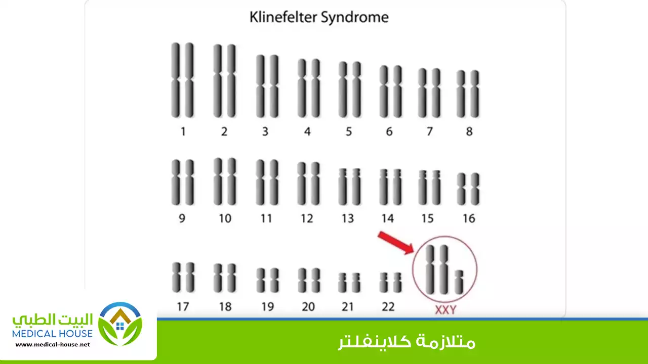 متلازمة كلاينفلتر