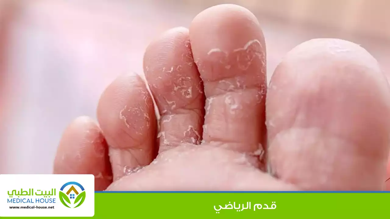 ماذا تعرف عن قدم الرياضي؟
