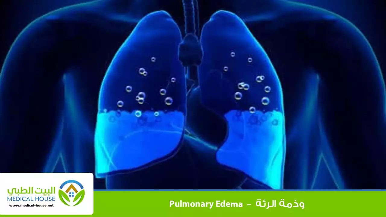 وذمة الرئة