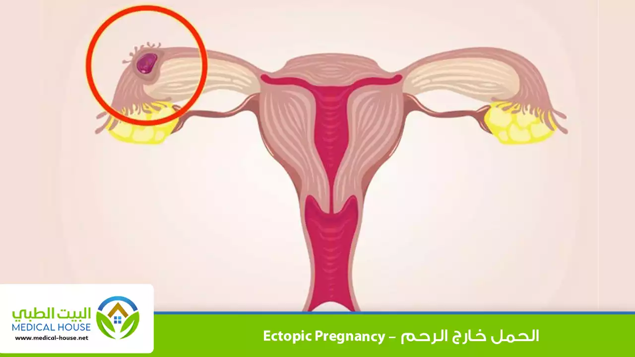 الحمل خارج الرحم
