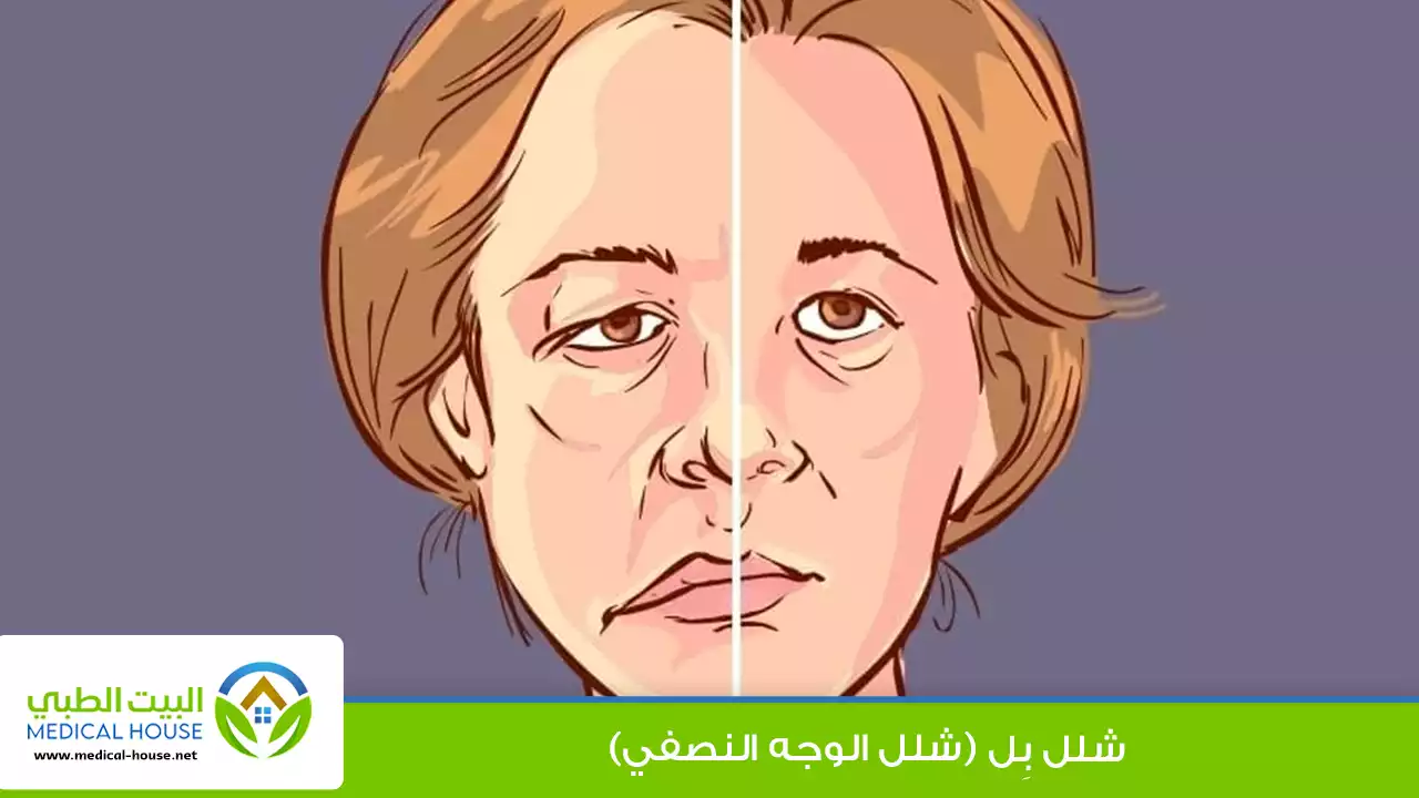 شلل بل (شلل الوجه النصفي)