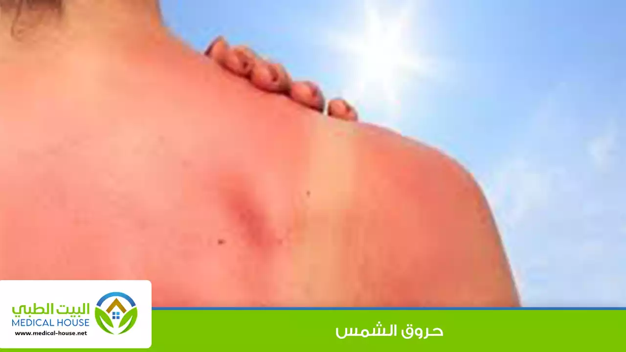 حروق الشمس