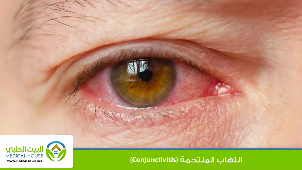 التهاب الملتحمة