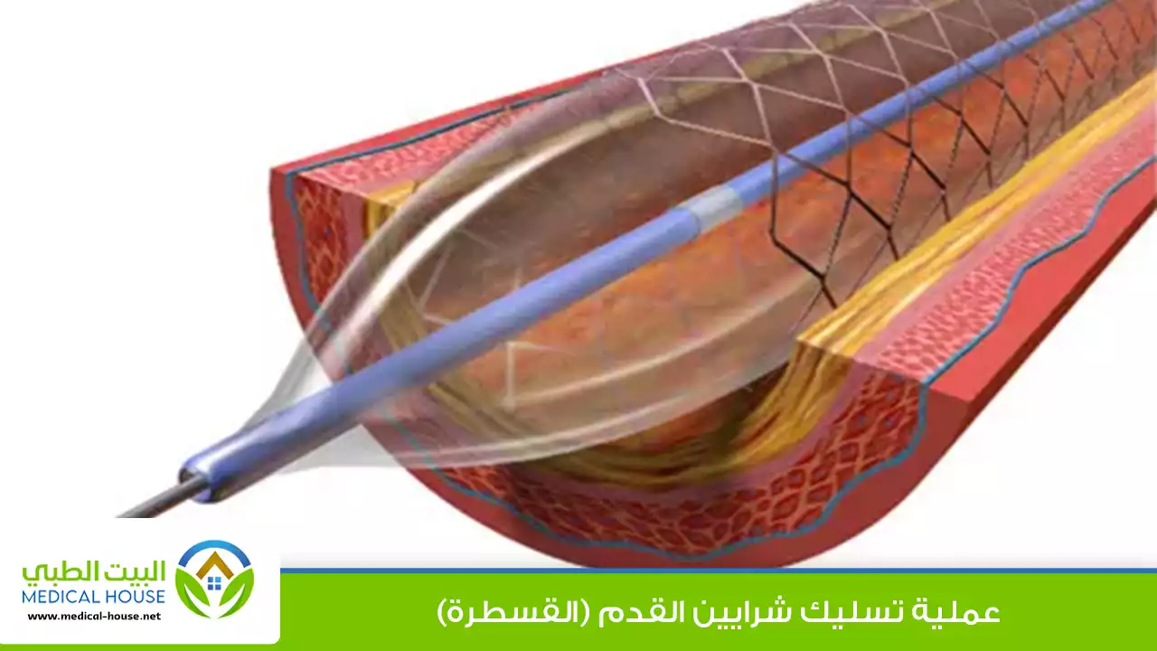 عملية تسليك شرايين القدم (القسطرة)