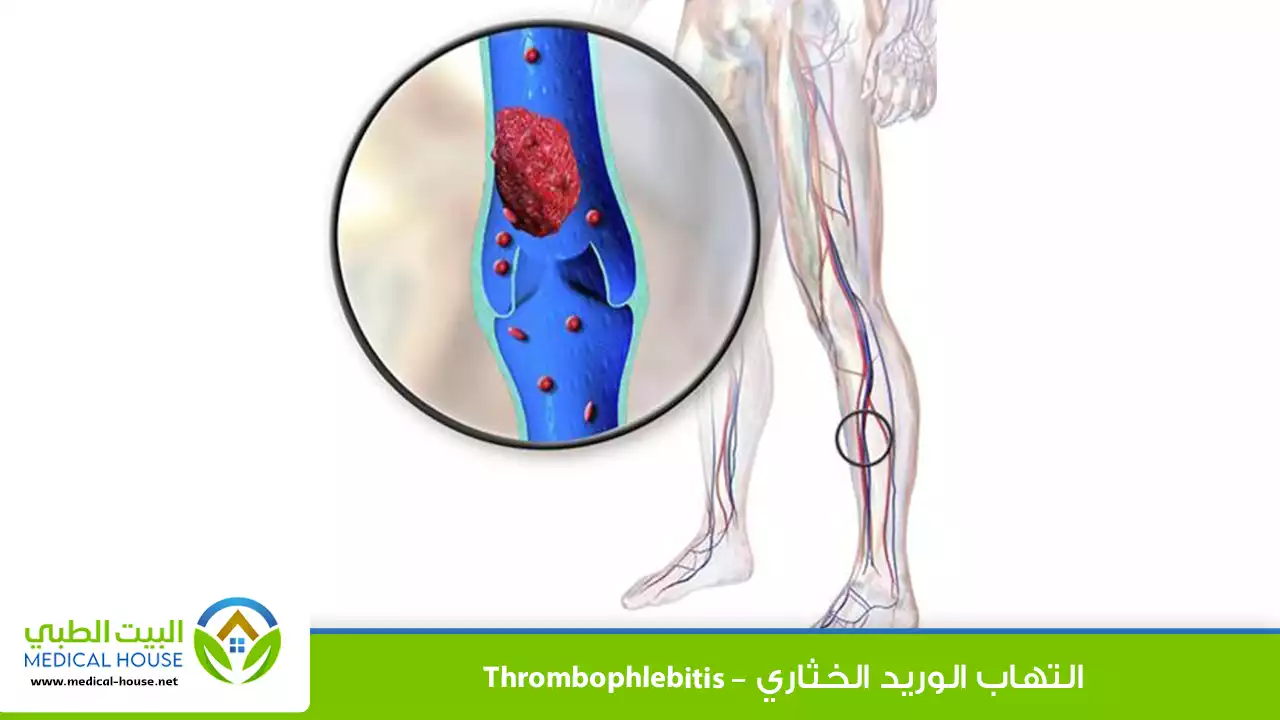 التهاب الوريد الخثاري