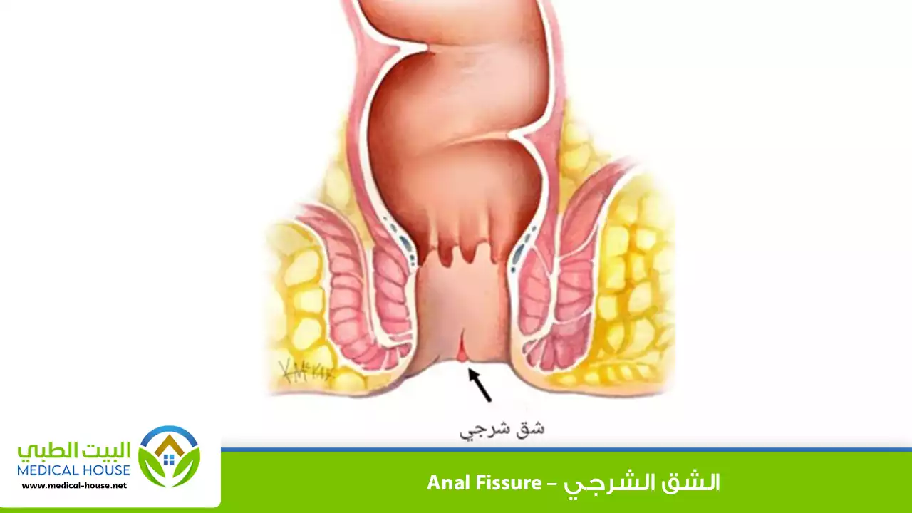 الشق الشرجي