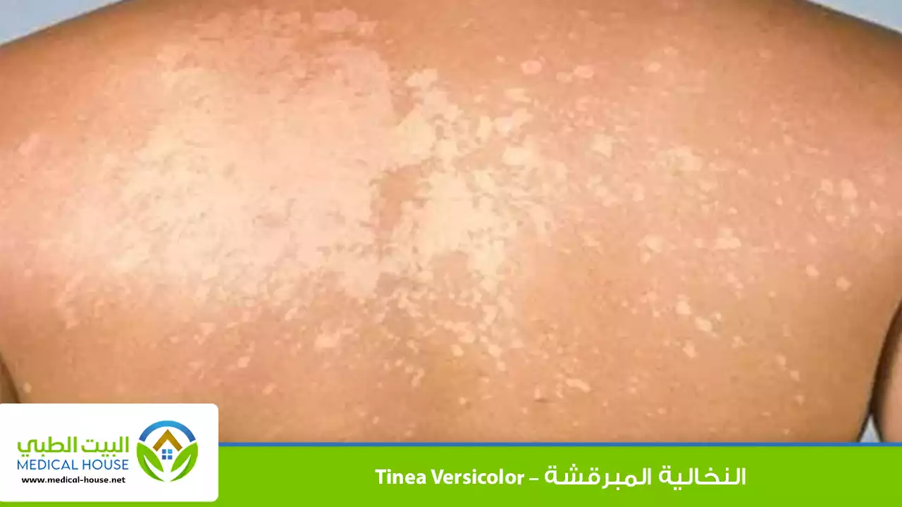 النخالية المبرقشة