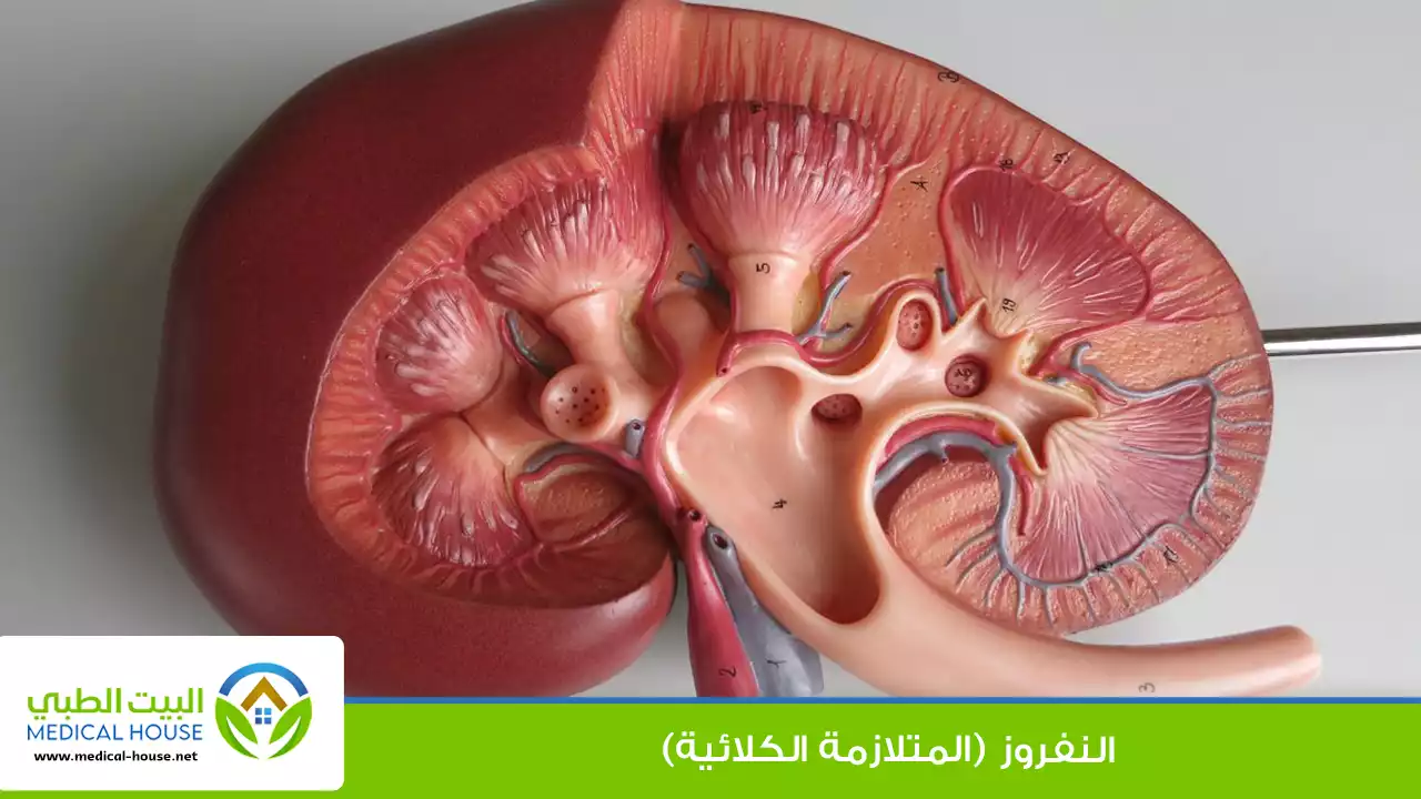 النفروز (المتلازمة الكلائية)