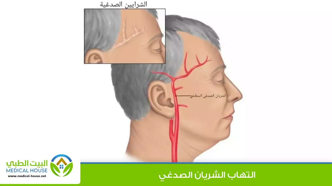 التهاب الشريان الصدغي