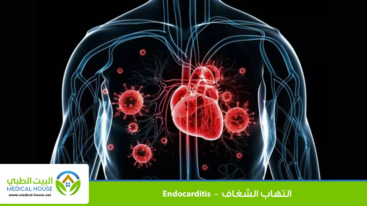 التهاب الشغاف