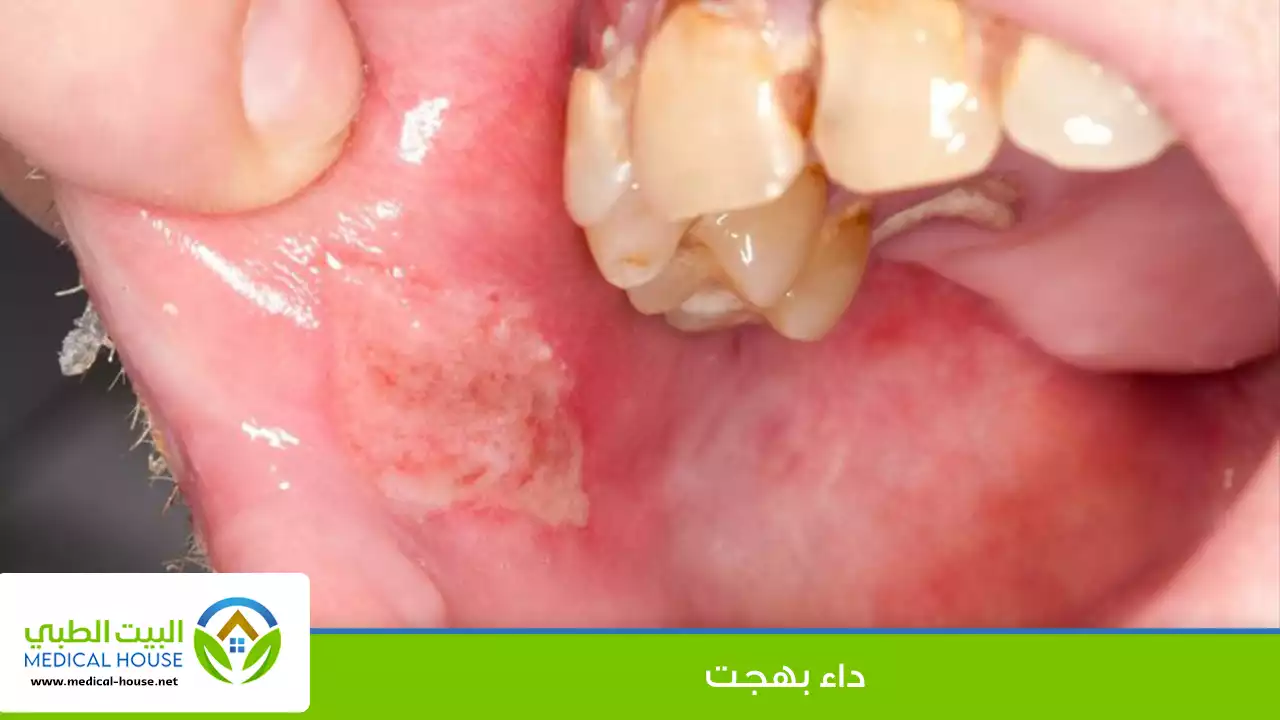 داء بهجت