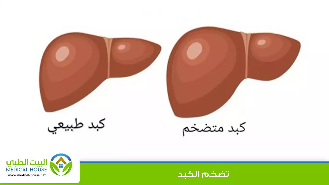 ما الذي يسبب تضخم الكبد؟