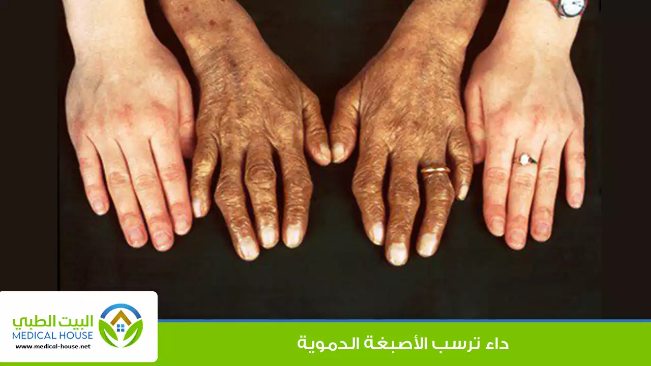 داء ترسب الأصبغة الدموية