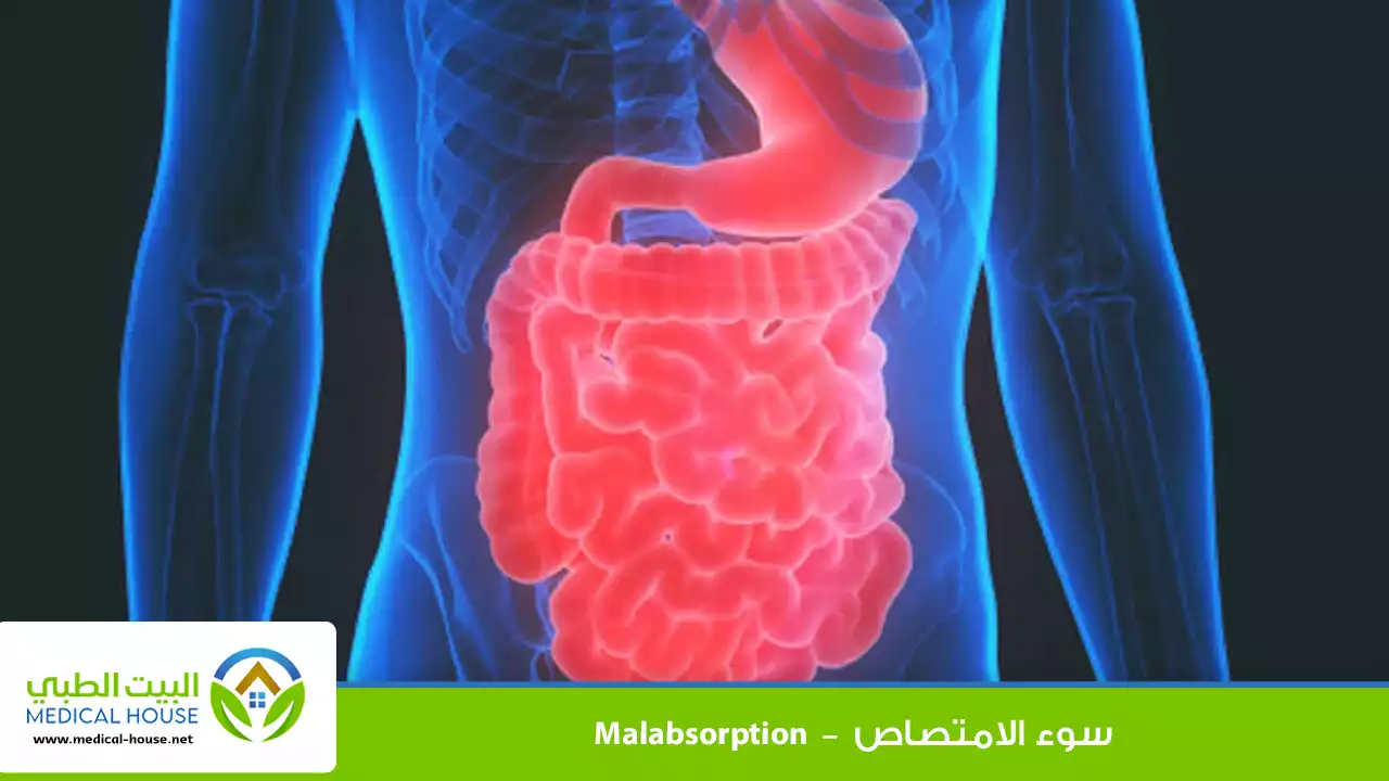 سوء الامتصاص