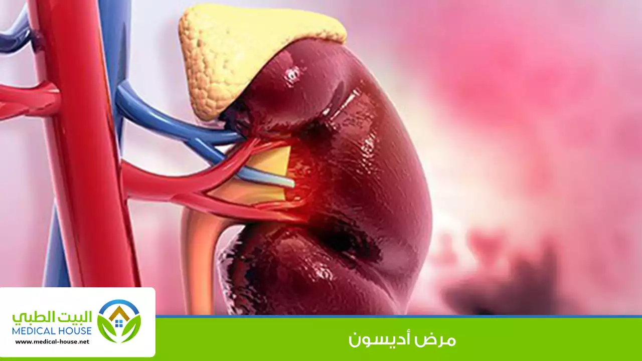 مرض أديسون