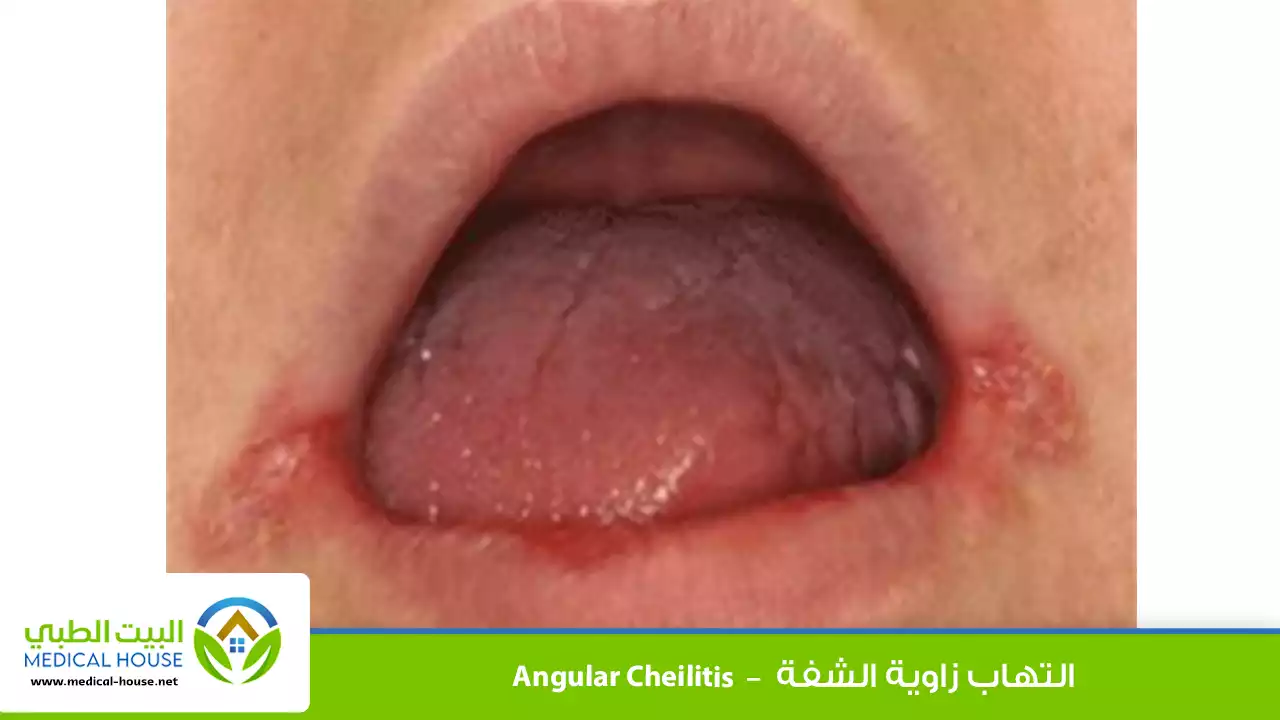 التهاب زاوية الشفة