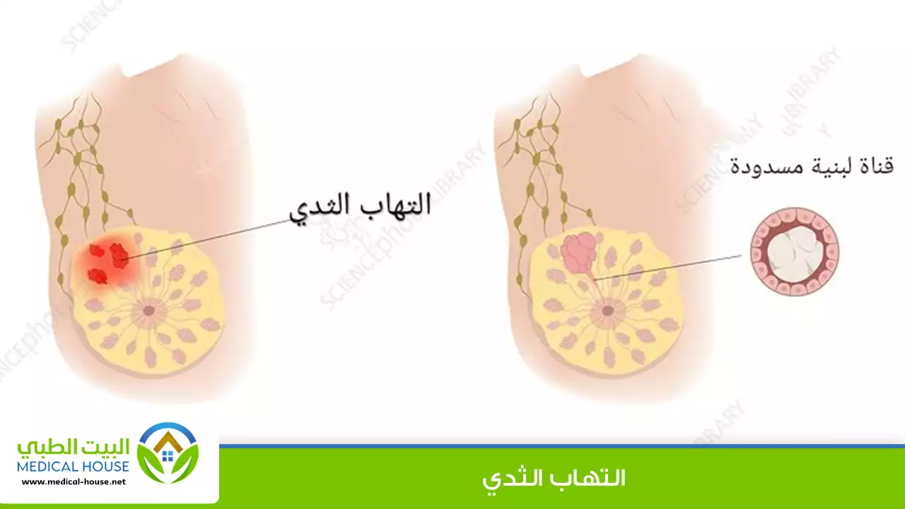 التهاب الثدي: الأسباب والعلاج والوقاية