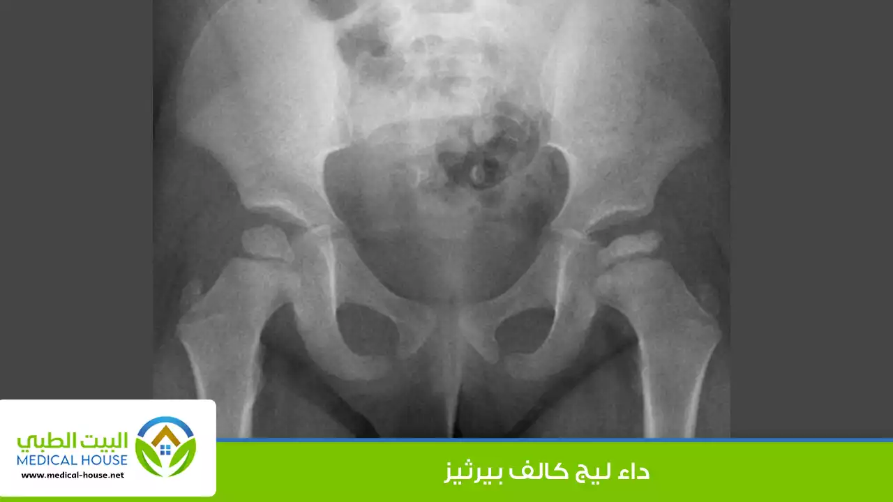 ماذا تعرف عن داء ليج كالف بيرثيز؟