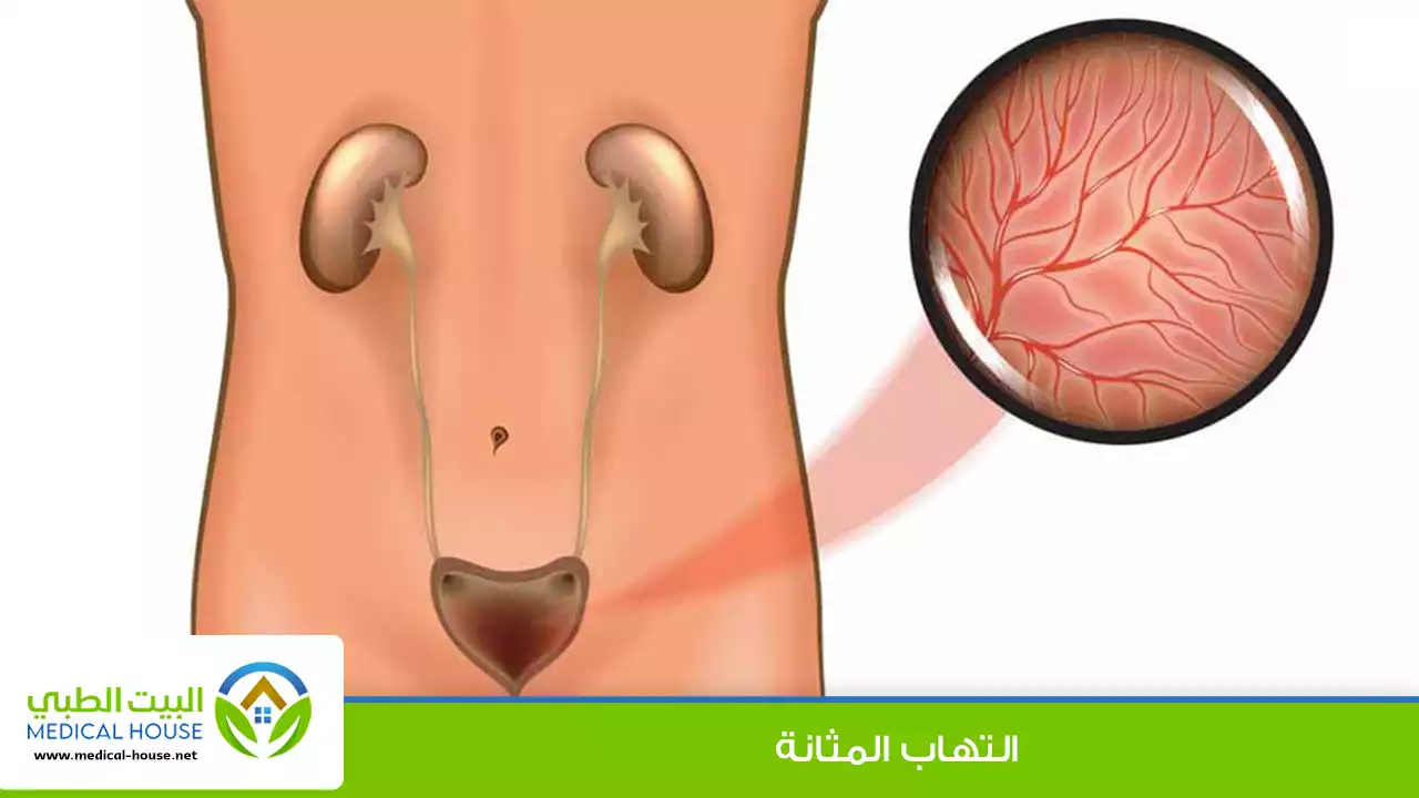 التهاب المثانة