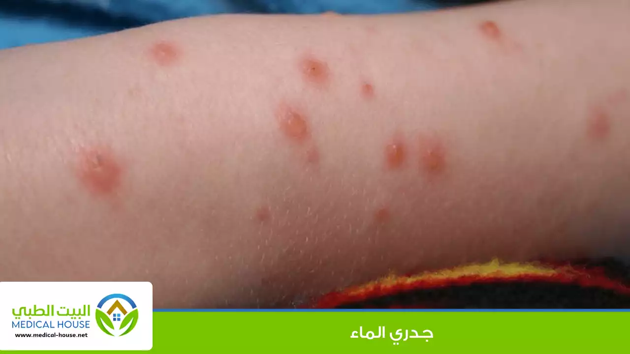 جدري الماء