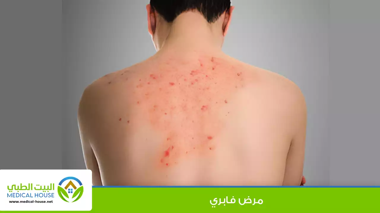 مرض فابري