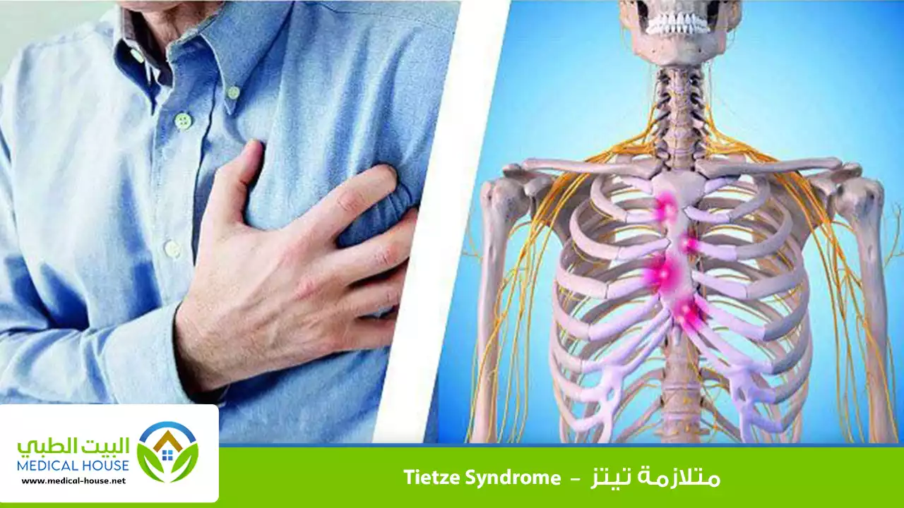 ماذا تعرف عن متلازمة تيتز؟