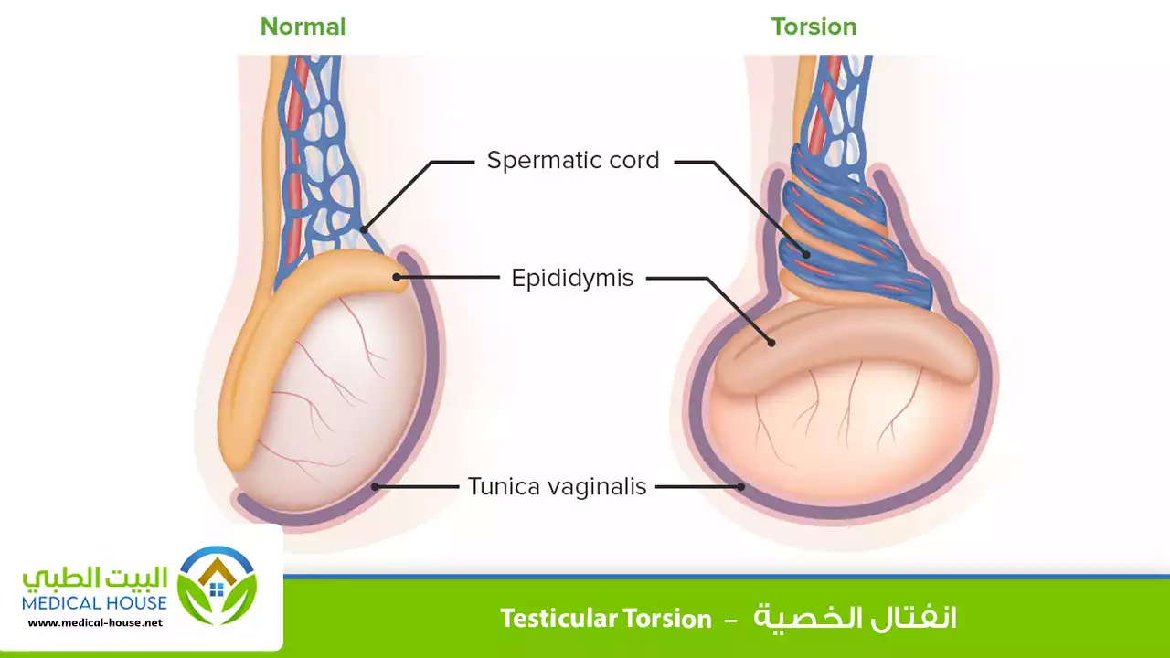 ما هو انفتال الخصية