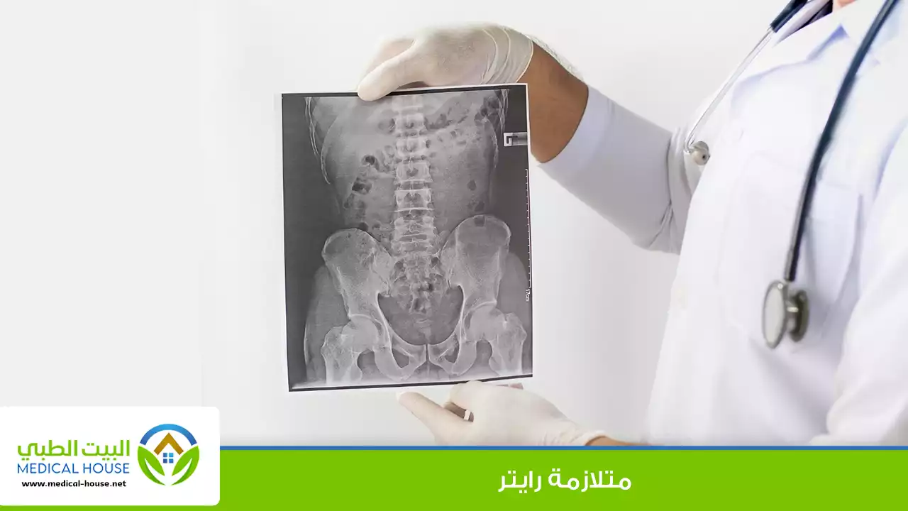 متلازمة رايتر