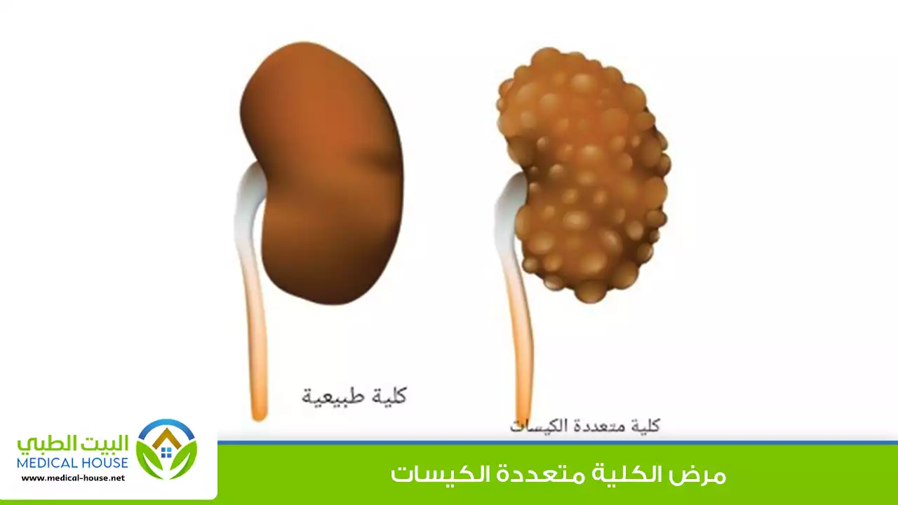 مرض الكلى متعددة الكيسات