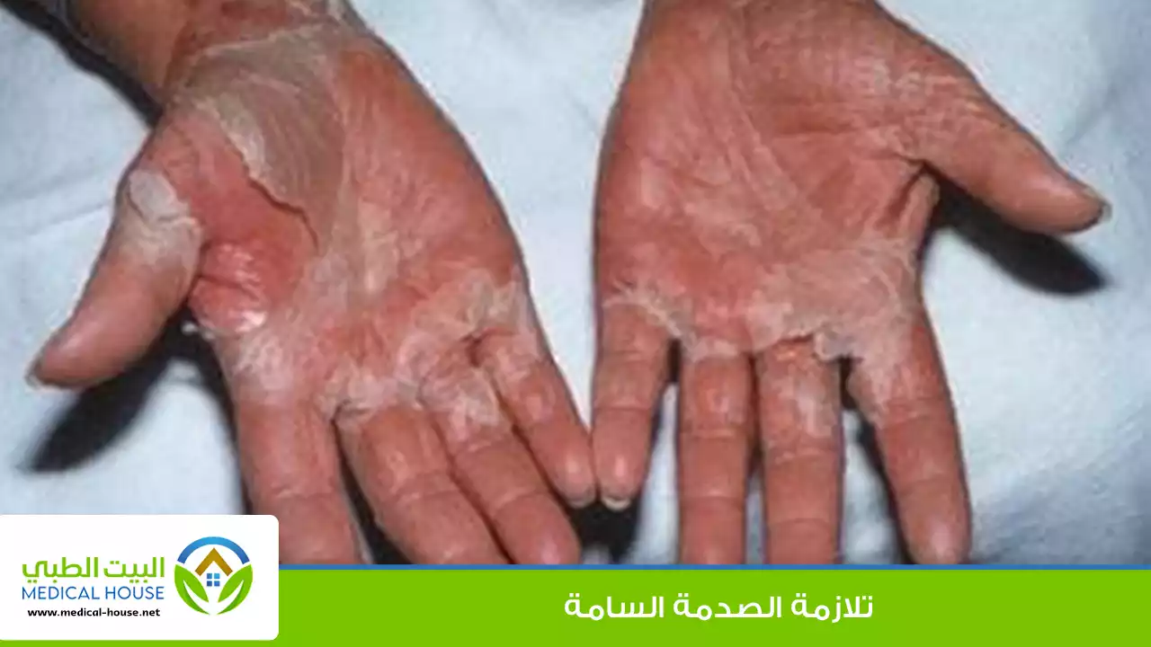 متلازمة الصدمة السامة