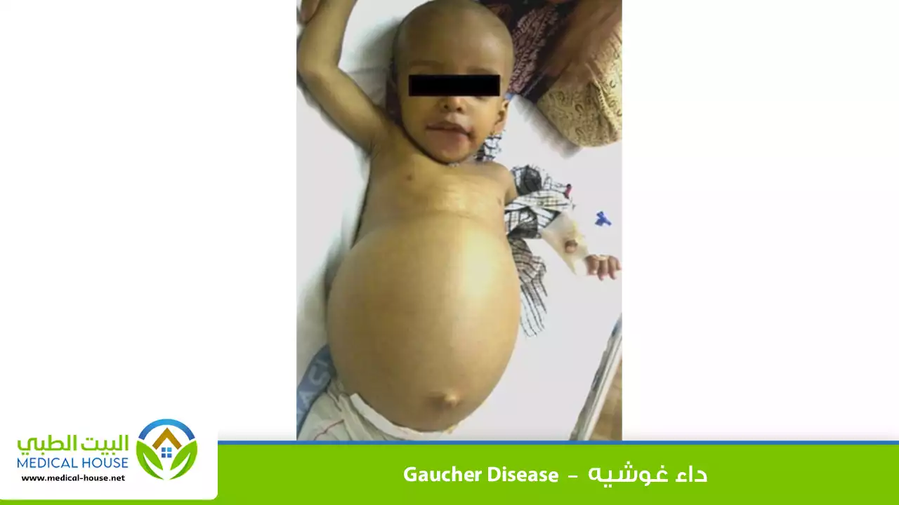 داء غوشيه