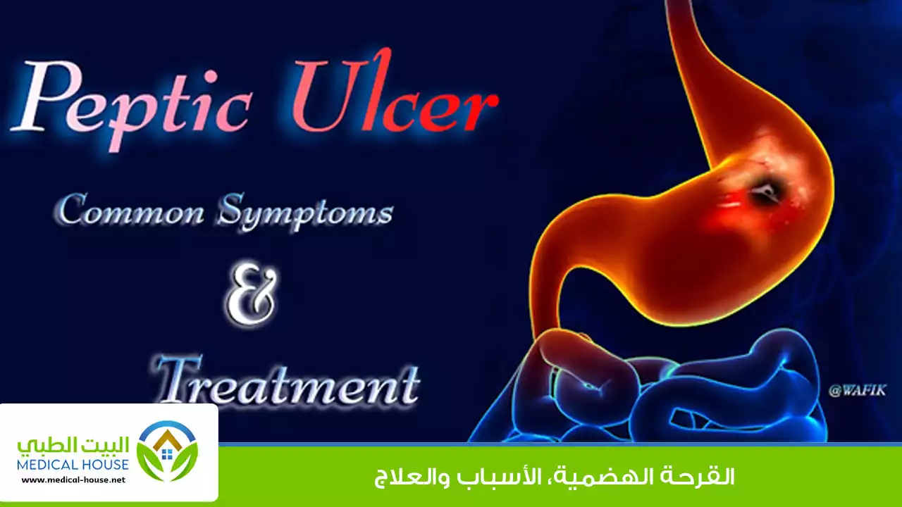القرحة الهضمية (الاسباب والعلاج)