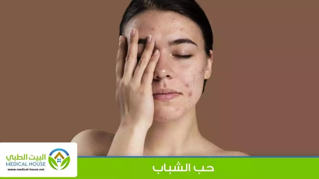 كل ما تريد معرفته عن حب الشباب