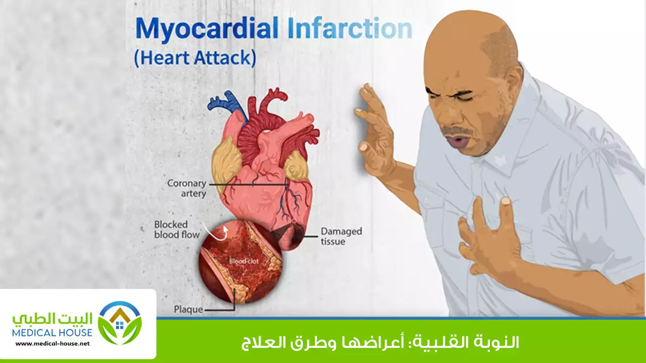 أعراض النوبة القلبية