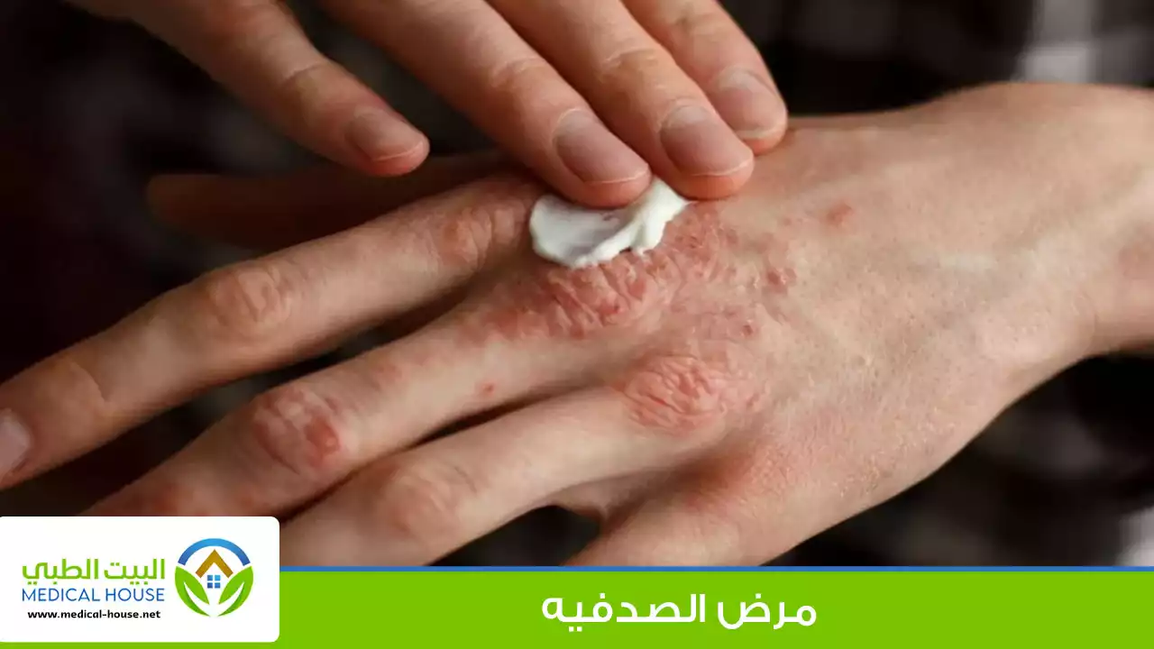 ماذا تعرف عن مرض الصدفية؟
