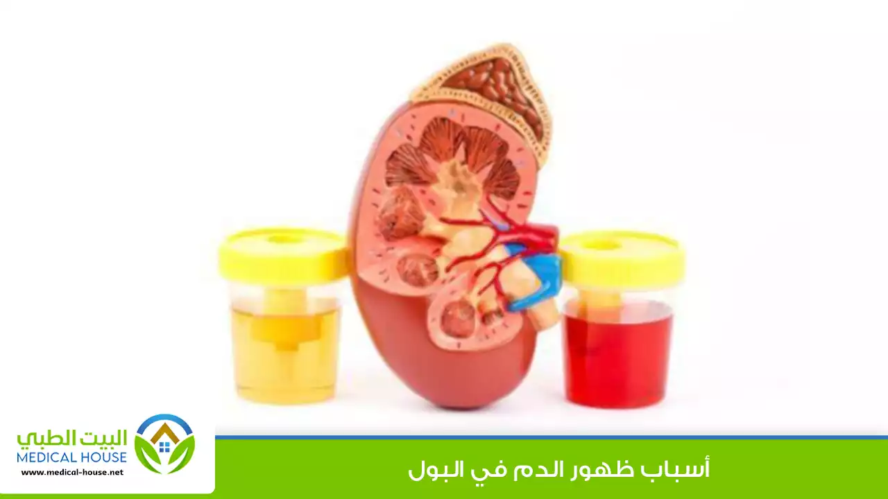 أسباب ظهور الدم في البول