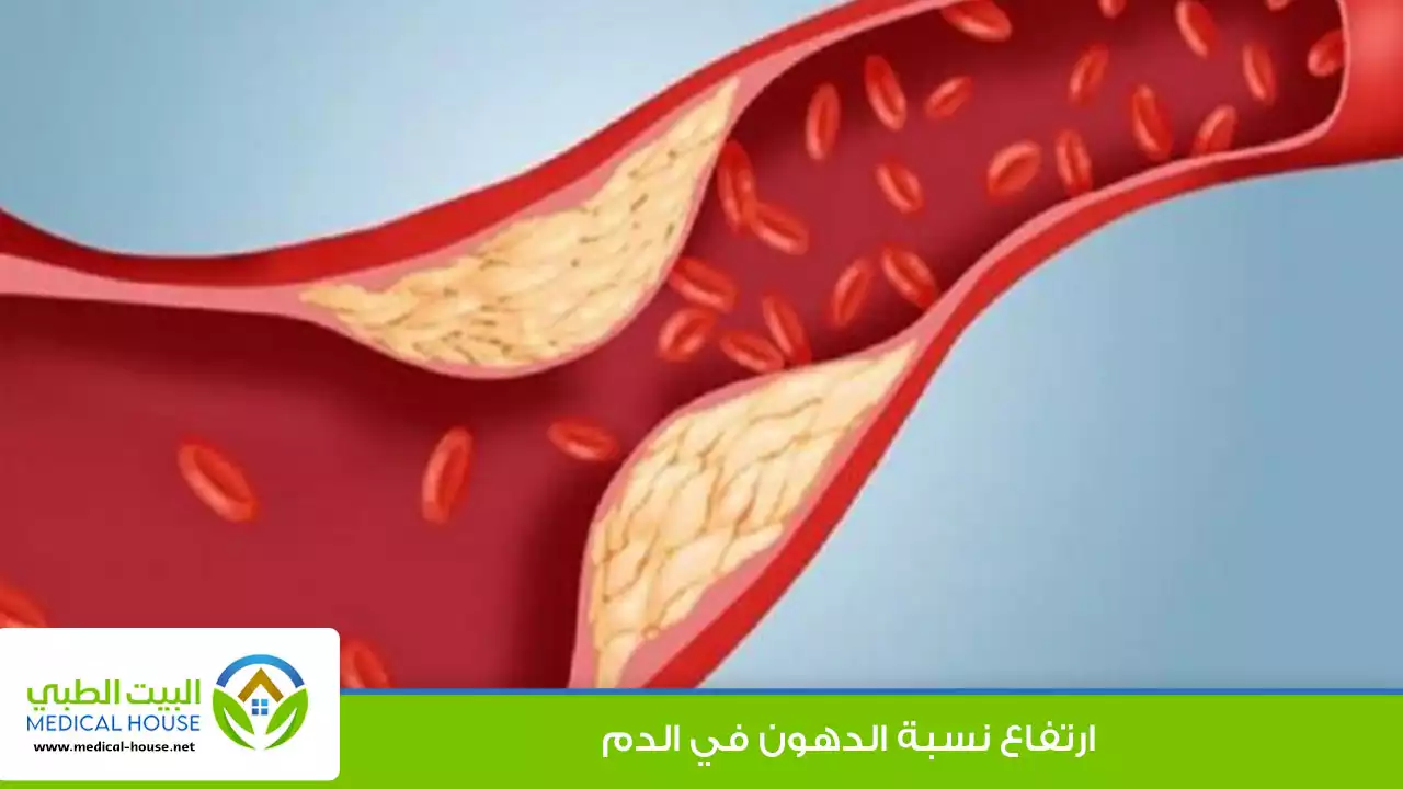 ارتفاع نسبة الدهون في الدم الأعراض والعلاج